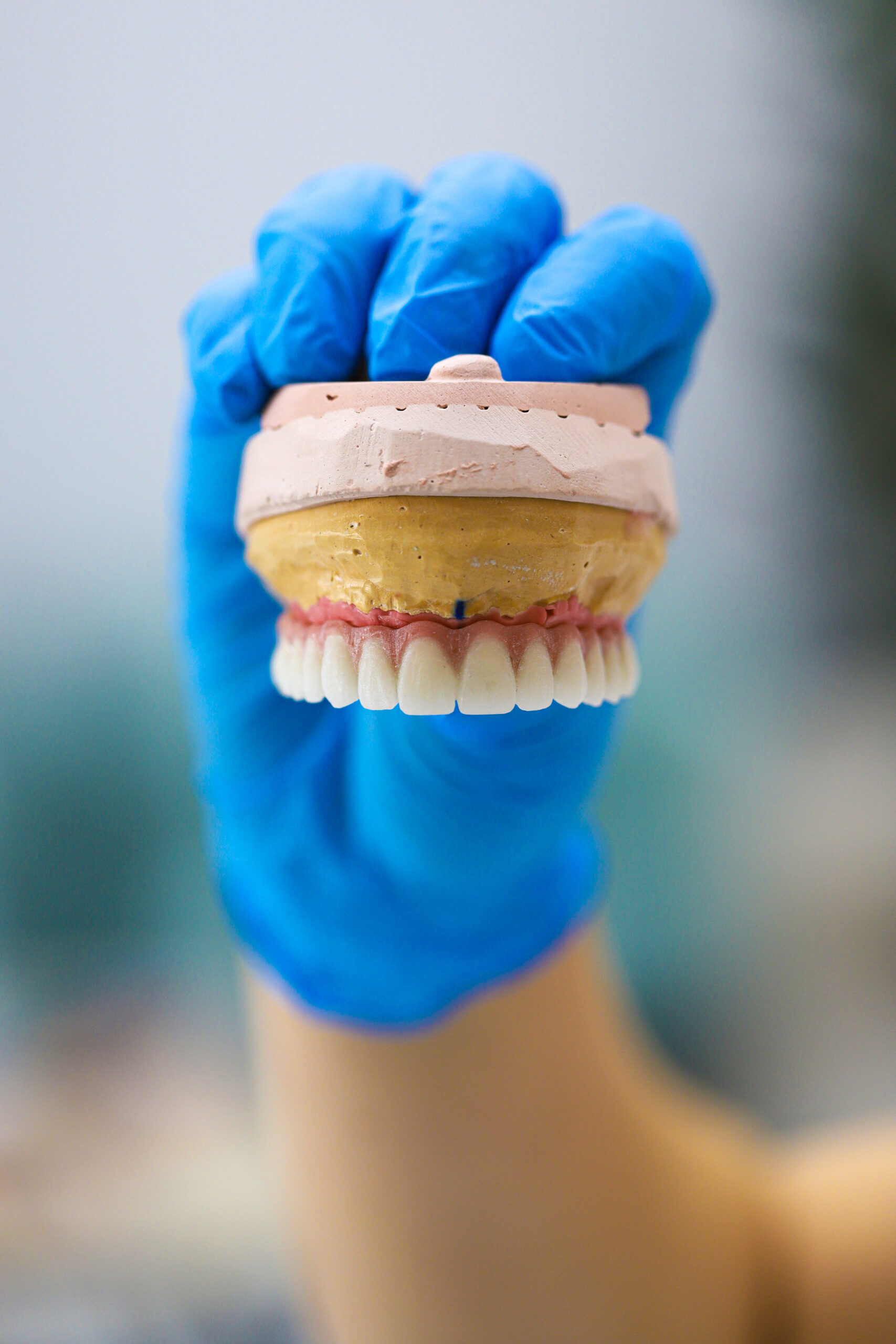 Full-arch porcelain implant-supported dental prosthesis for edentulous jaws with All-on-X and All-on-4 treatment procedure using dental implant surgery.