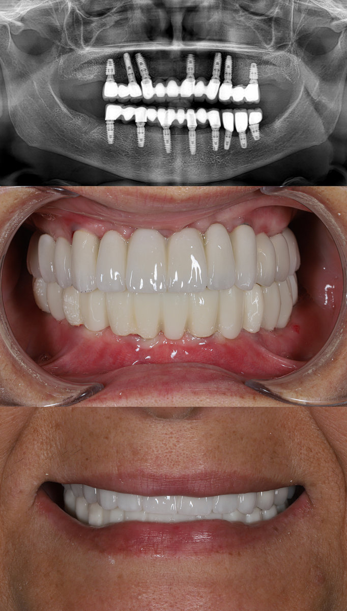 Full-arch porcelain implant-supported dental prosthesis for edentulous jaws with All-on-X and All-on-4 treatment procedure using dental implant surgery.