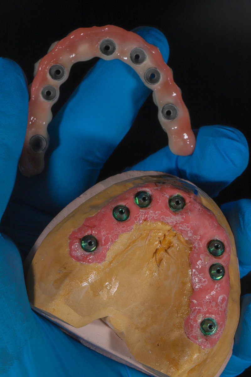 Dental prosthetic model with implants