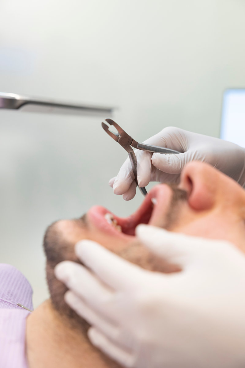 Dentist in gloves extracting a tooth from a man's open mouth in a clinic