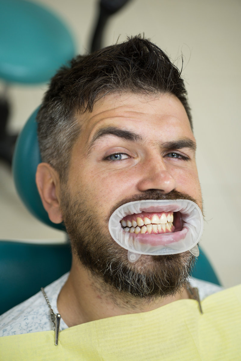 Comparison after teeth whitening. Teach patients about diets, flossing, the use of fluoride, and other aspects of dental care