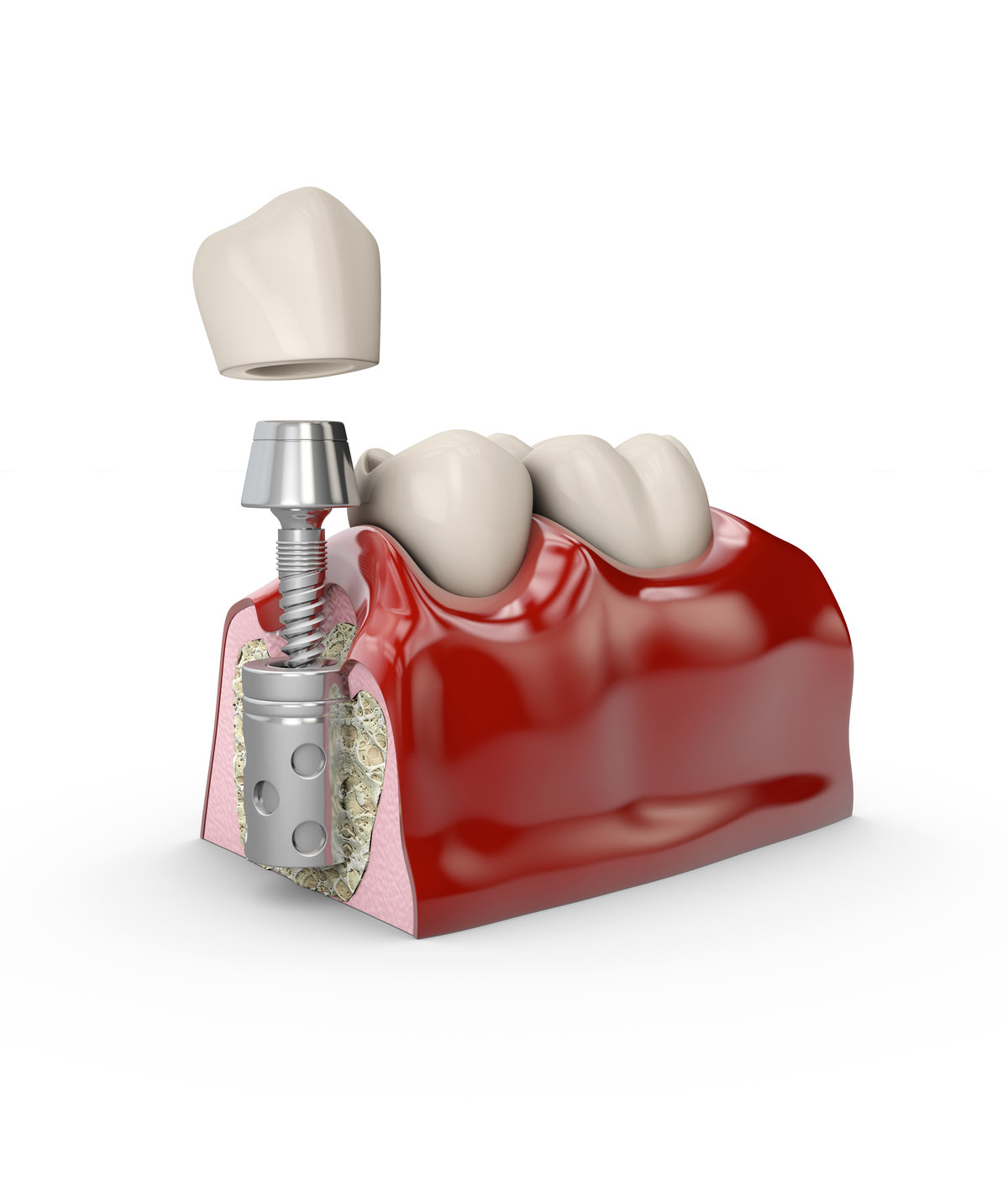 Anatomy of healthy teeth and dental implant in jaw bone. Stomatology concept 3d illustration
