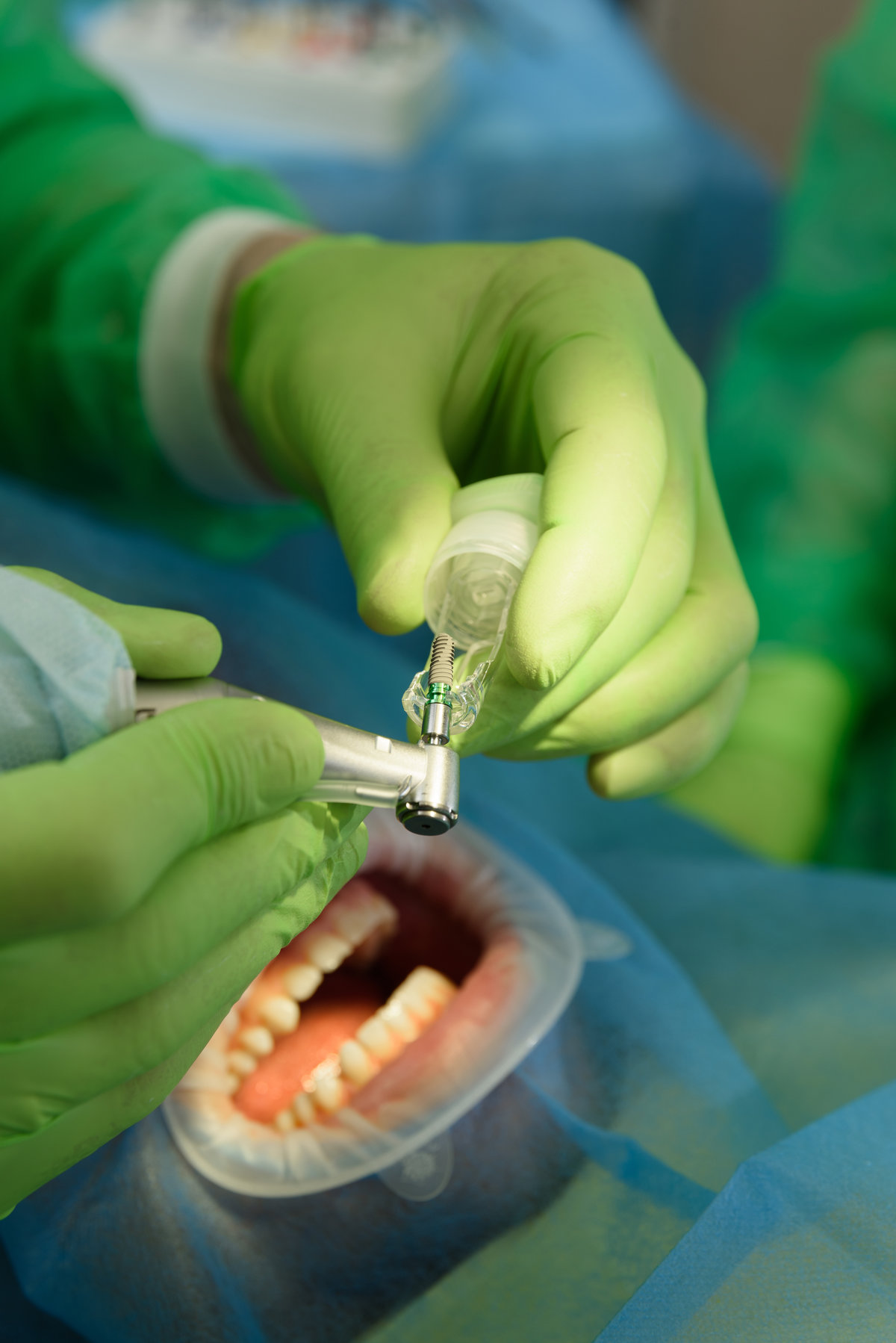 Close-up shot of attentive doctors performing surgical operation installing dental implants into patient's mouth. Dental instruments. Stomatology clinic. Dental surgery.