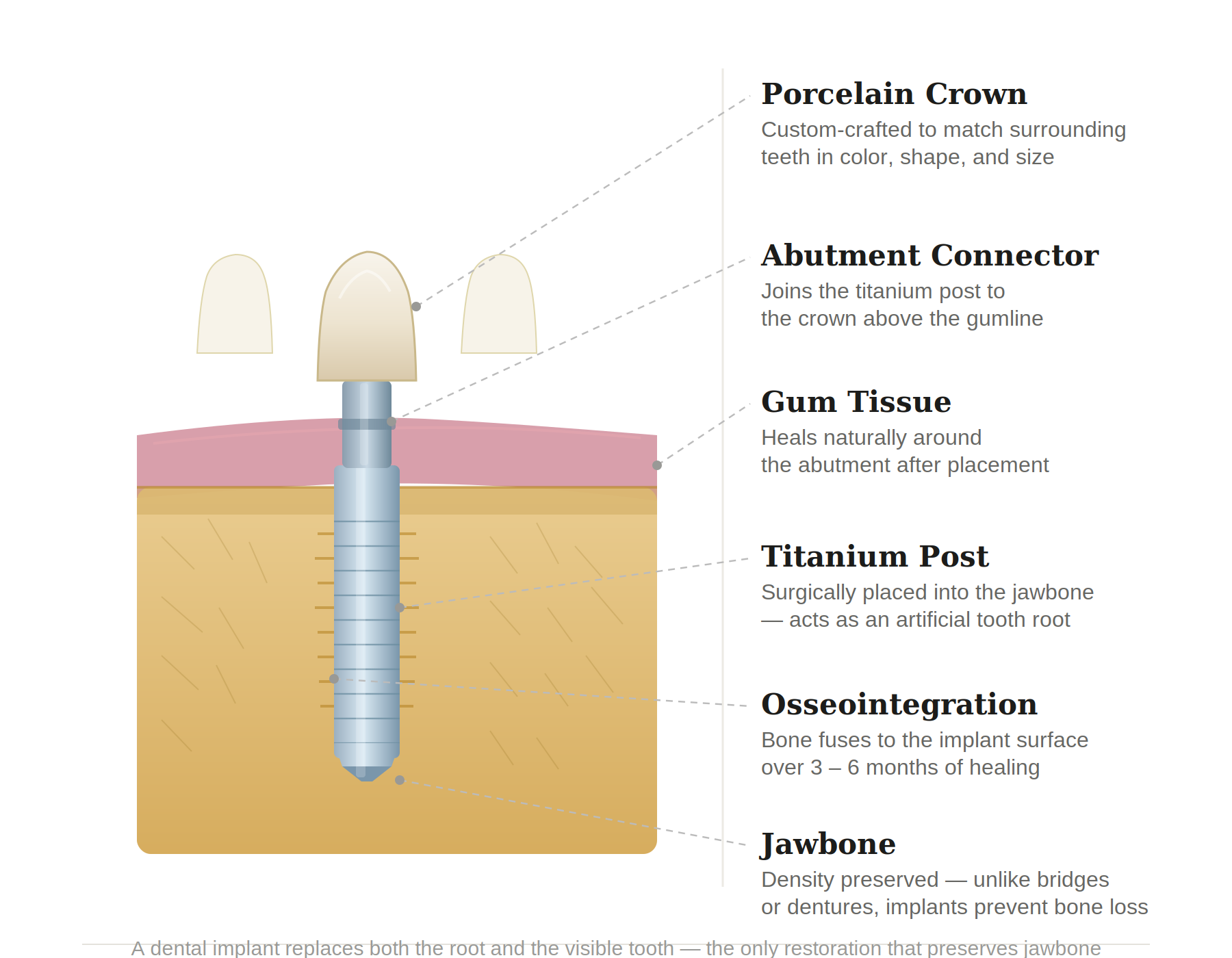 Dental implant anatomy diagram showing the three-part structure: porcelain crown, abutment connector, and titanium post fused to the jawbone through osseointegration